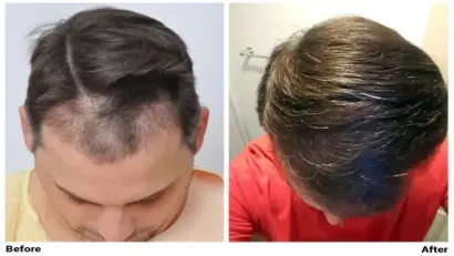 Hair Loss: Joe Tillman and the Emotional Fallout