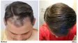 Hair Loss: Joe Tillman and the Emotional Fallout
