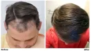 Hair Loss: Joe Tillman and the Emotional Fallout