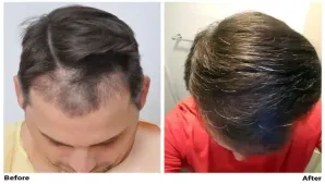 Hair Loss: Joe Tillman and the Emotional Fallout