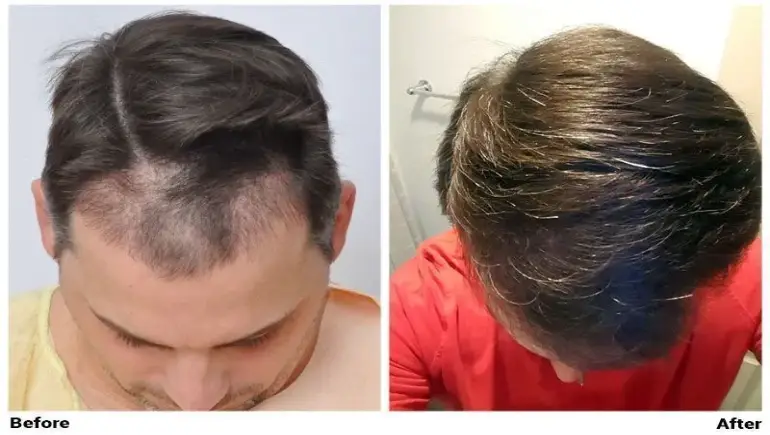 Hair Loss: Joe Tillman and the Emotional Fallout