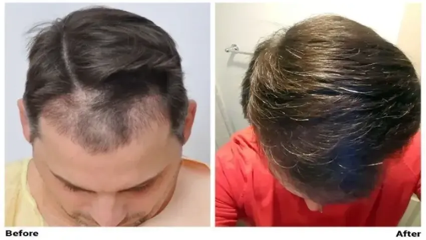 Hair Loss: Joe Tillman and the Emotional Fallout